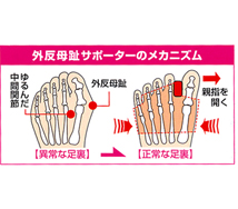 外反母趾サポーター W 仕組み